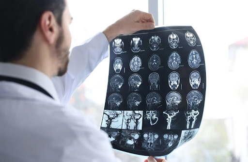 MRIs and CT Scans Often Miss Traumatic Brain Injuries